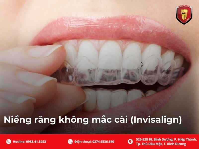 Niềng răng không mắc cài (Invisalign)
