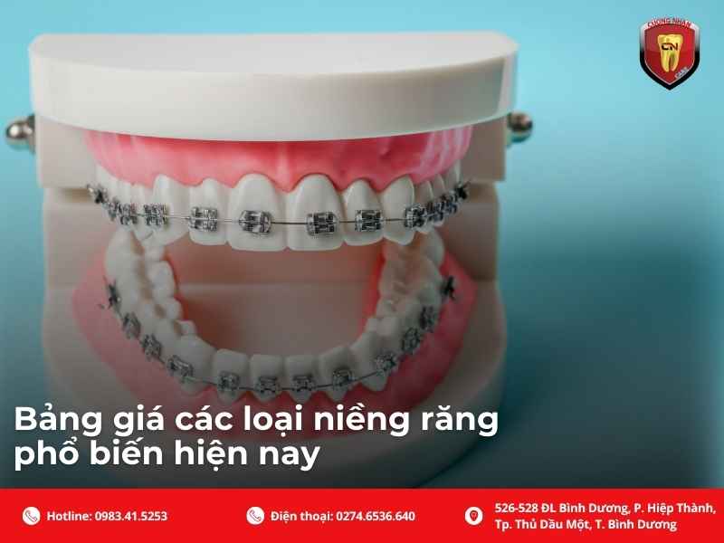 Bảng giá các loại niềng răng phổ biến hiện nay
