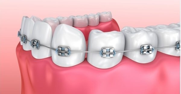 Niềng răng có ảnh hưởng đến sức khỏe không