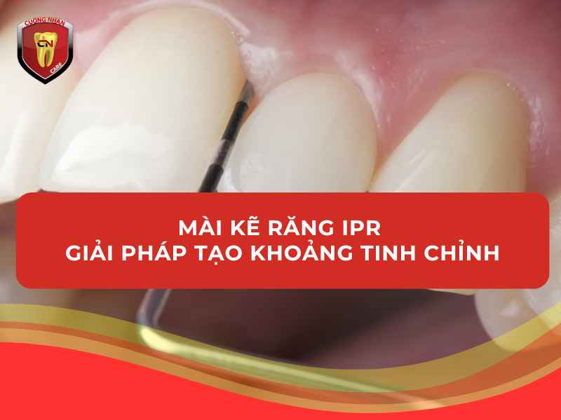 Mài kẽ răng IPR – Giải pháp tạo khoảng tinh chỉnh