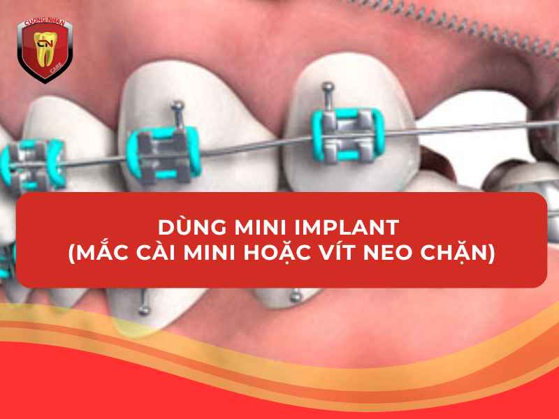 Dùng Mini Implant (Mắc cài mini hoặc vít neo chặn)