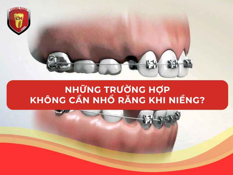 Những trường hợp không cần nhổ răng khi niềng?