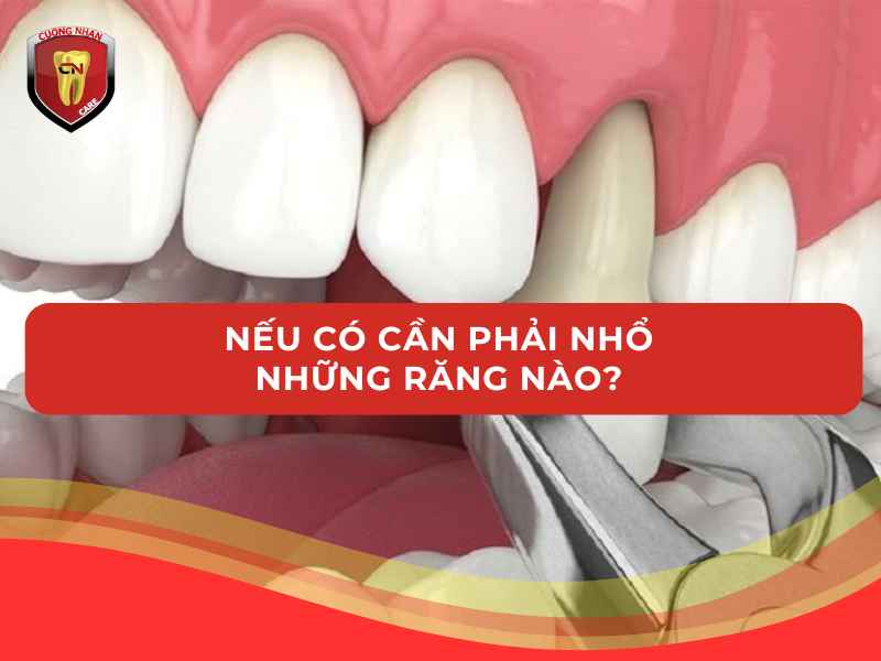Nếu có cần phải nhổ những răng nào?