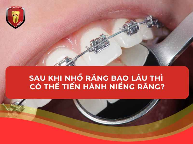 Thời gian niềng có thể là sau 2 - 3 tuần sau khi nhổ