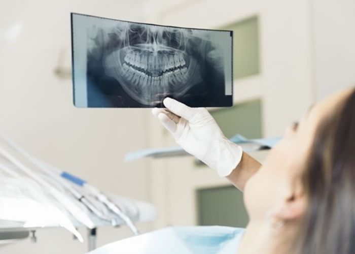 Nhổ răng giúp quá trình niềng răng diễn ra tốt nhất