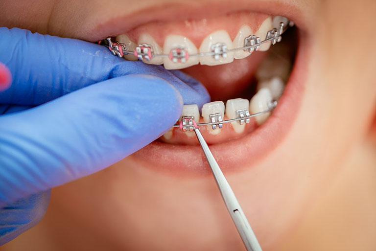 Niềng răng là gì? Niềng răng có thật sự mang lại hiệu quả không?
