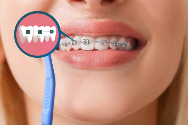 Niềng răng là gì? Phương pháp niềng răng chỉnh nha hiện nay có bao nhiêu loại?