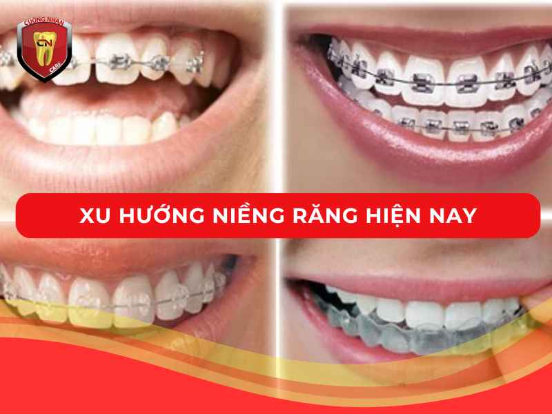 Nói về xu hướng niềng răng hiện nay
