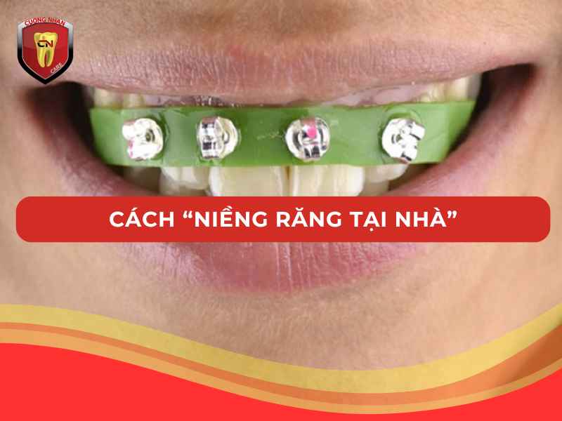 Các cách niềng răng tại nhà được truyền tai nhau hiện nay