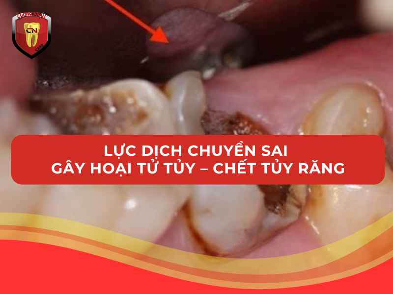 Lực dịch chuyển sai gây hoại tử tủy – chết tủy răng