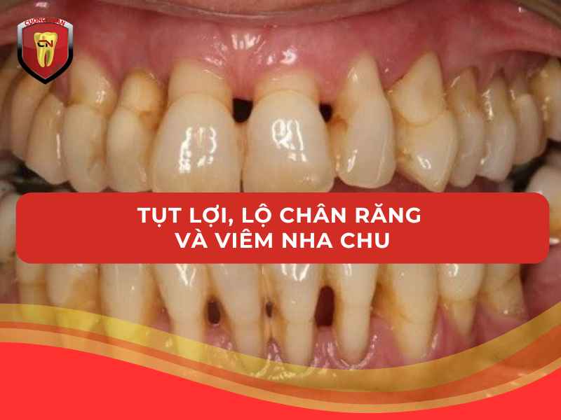 Tụt lợi, lộ chân răng và viêm nha chu