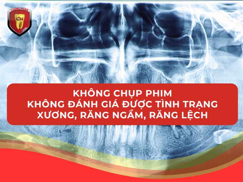 Không chụp phim – không đánh giá được tình trạng xương, răng ngầm, răng lệch