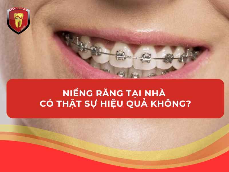 Niềng răng tại nhà không phải là lựa chọn tốt nhất để niềng răng
