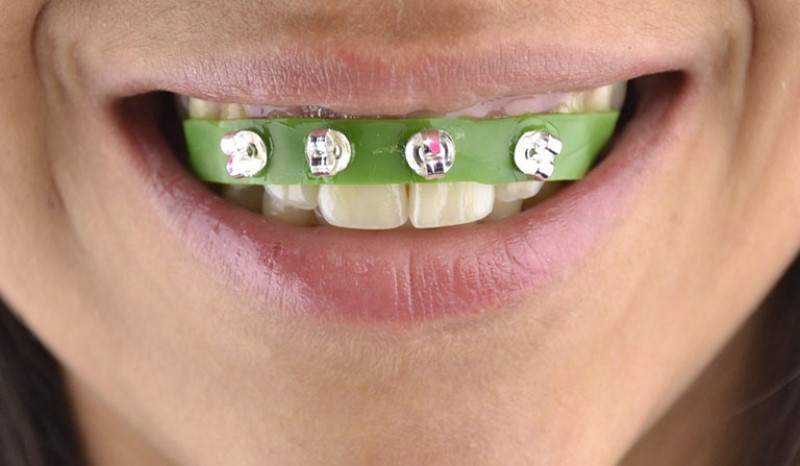 Niềng răng tại nhà có hiệu quả không?