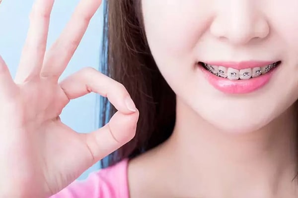19 tuổi niềng răng bao lâu và các yếu tố ảnh hưởng đến thời gian niềng
