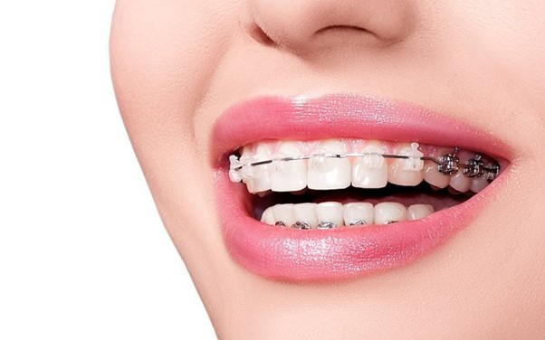 Stress khi niềng răng là một nguyên nhân dẫn tới hóp thái dương khi niềng răng