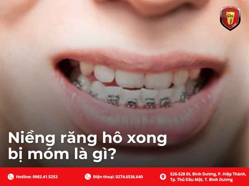 Tổng quan về vấn đề niềng răng hô xong bị móm