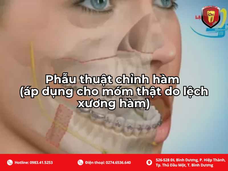 Phẫu thuật chỉnh hàm