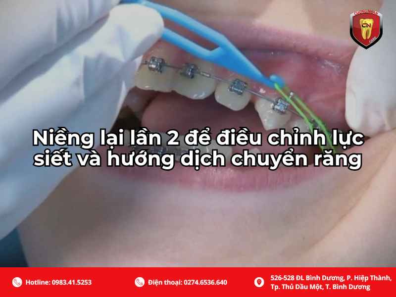 Niềng lại lần 2 để điều chỉnh lực siết và hướng dịch chuyển răng