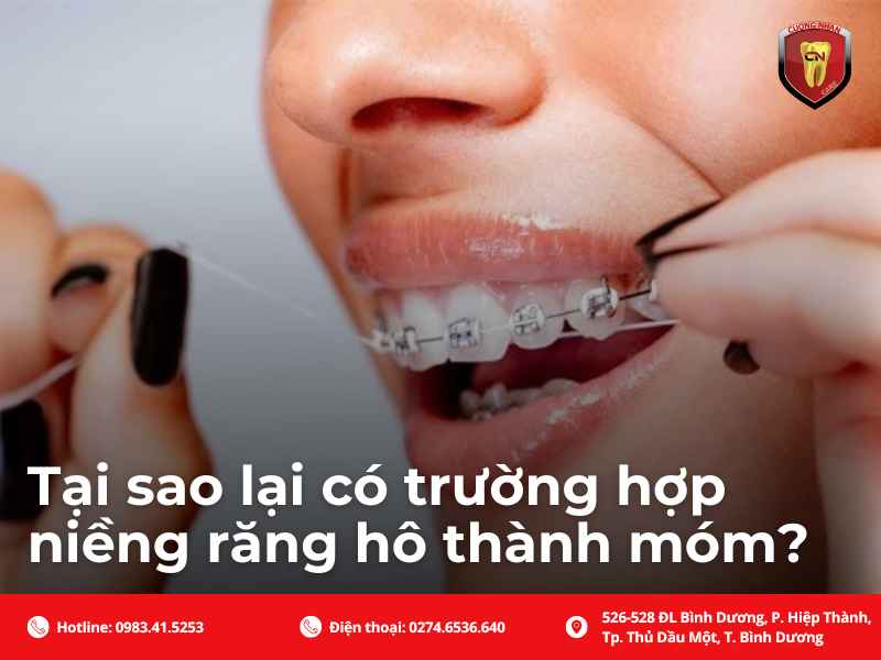 Tìm hiểu các nguyên nhân làm cho niềng răng hô xong lại thành móm