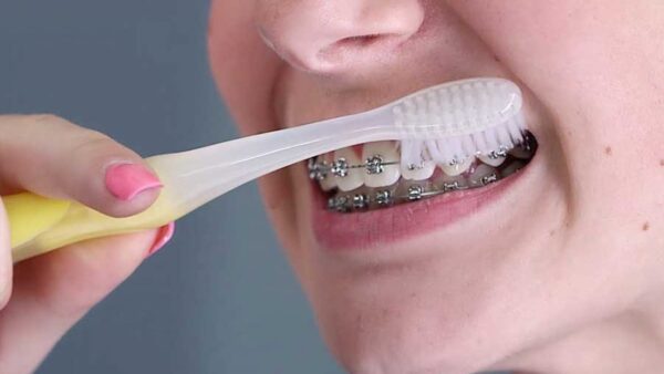 Cần có phải chăm sóc răng miệng đúng cách khi niềng răng 