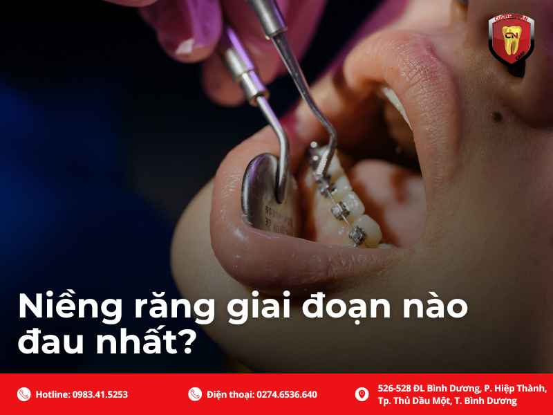 Tìm hiểu qua các giai đoạn niềng răng