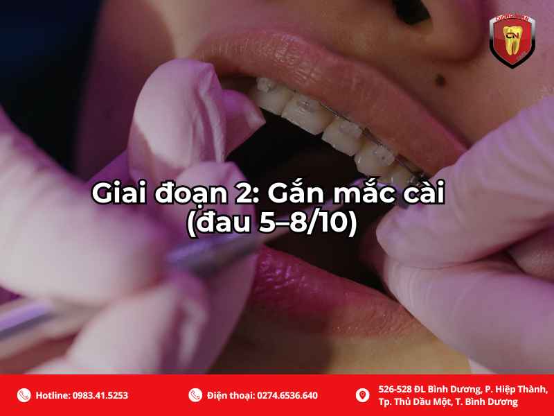 Giai đoạn gắn mác cài sẽ đau hơn so với giai đoạn 1