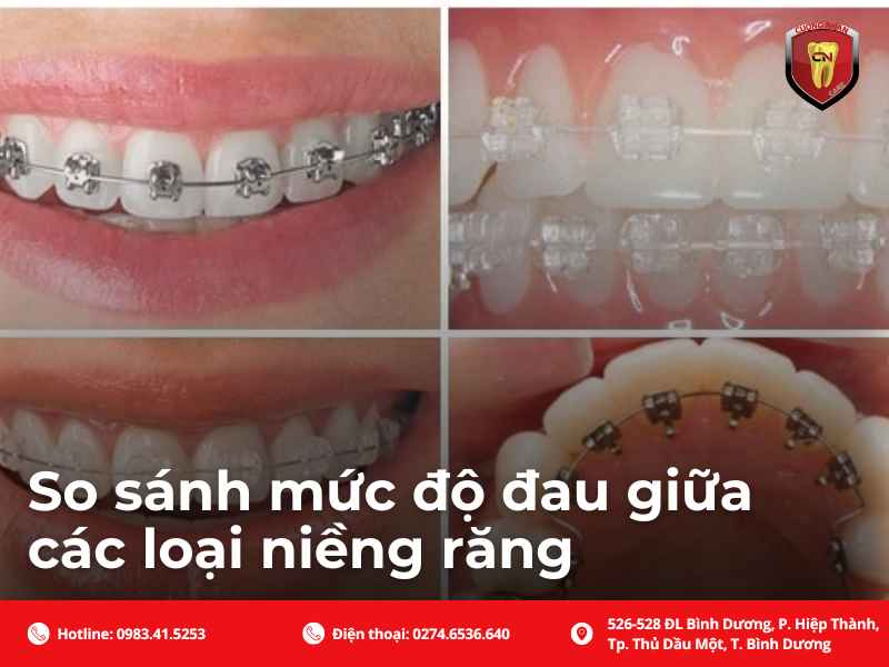 Cùng Nha Khoa Cường Nhân tìm hiểu về mức độ đau của các loại niềng răng