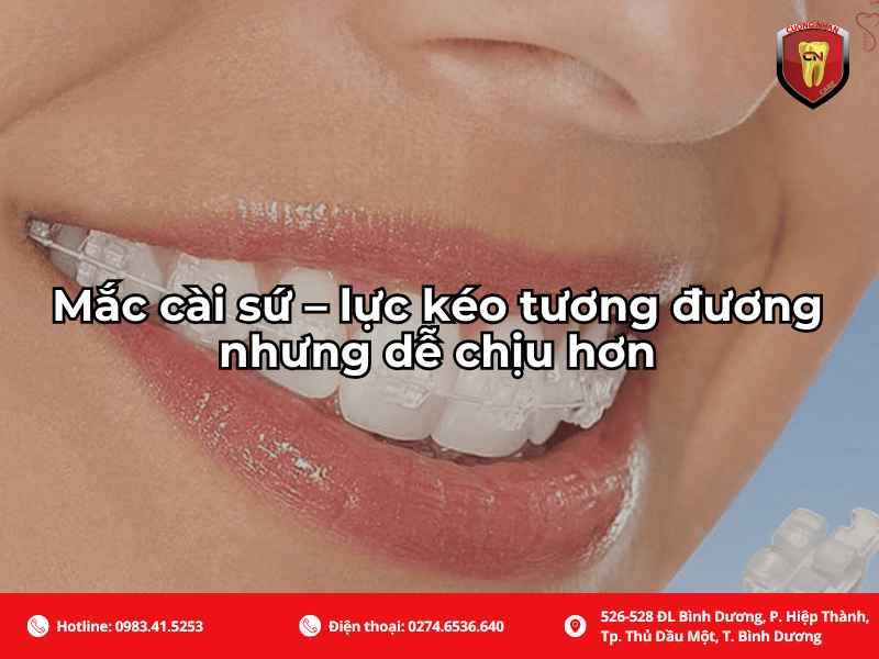 Niềng răng mắc cài sứ