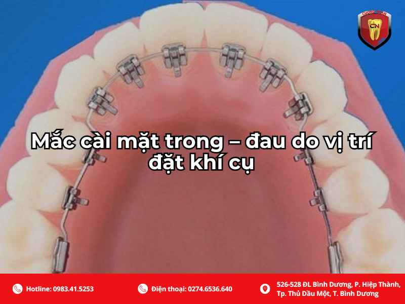Mẫu niềng răng mắc cài trong