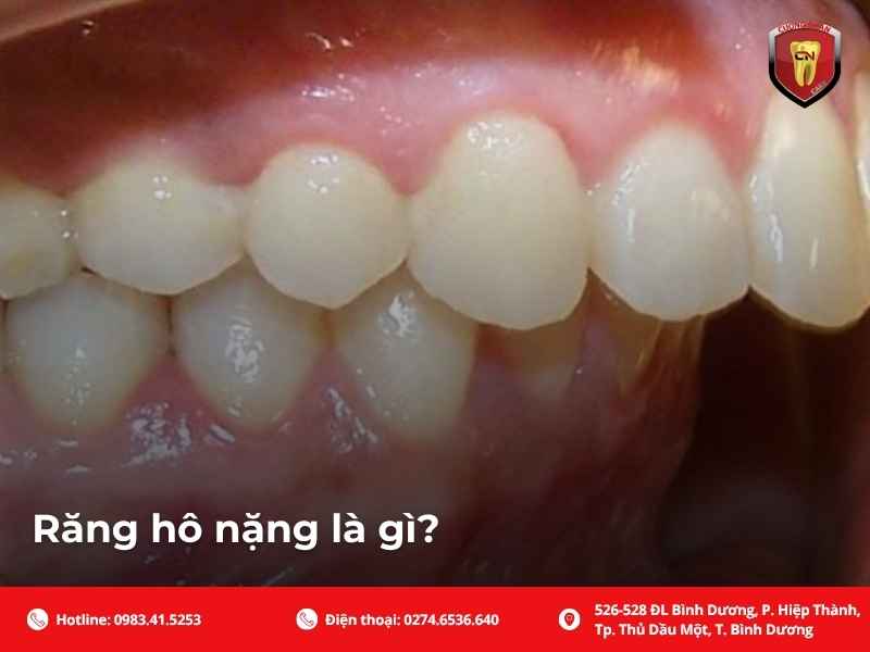 Răng hô nặng là gì?