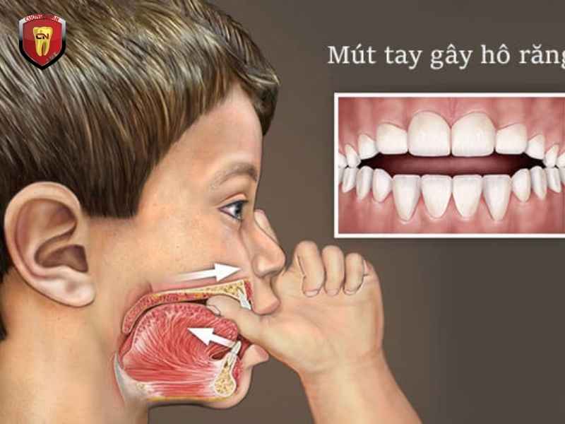 Răng hô do xương hàm