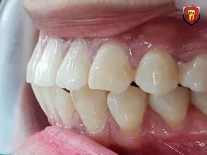 Tác hại của răng hô nặng