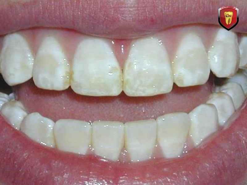 Giảm hiệu quả ăn nhai