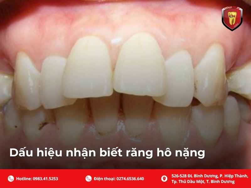 Dấu hiệu nhận biết răng hô nặng