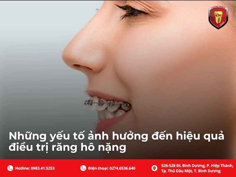 Những yếu tố ảnh hưởng đến hiệu quả điều trị răng hô nặng