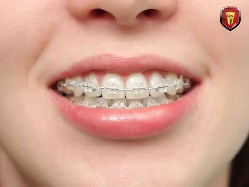 Tình trạng răng ban đầu