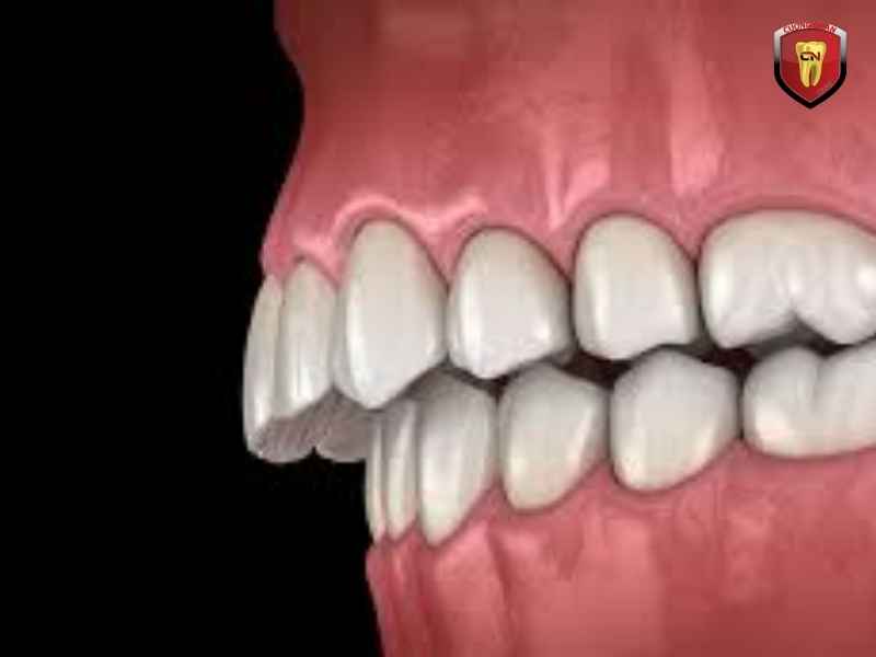 Hàm trên nhô ra phía trước