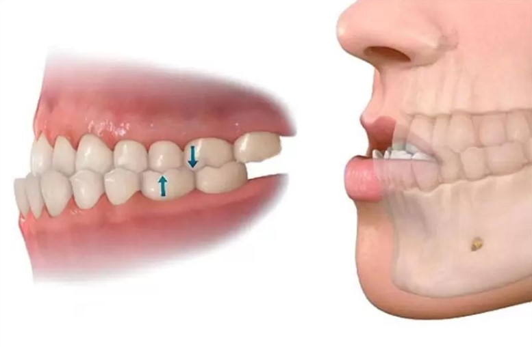 Nguyên nhân dẫn đến răng bị hô nặng