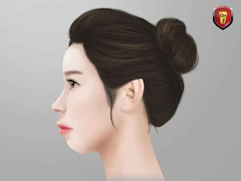 Môi trên nhô và khó khép miệng tự nhiên