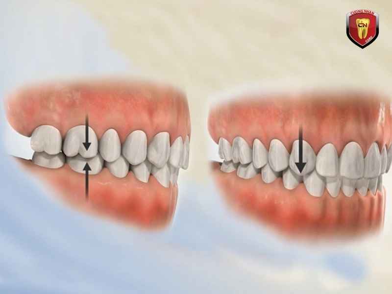 Khớp cắn không khớp