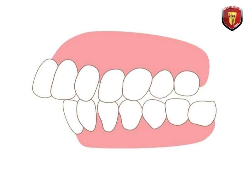 Nguyên nhân dẫn đến răng hô nặng