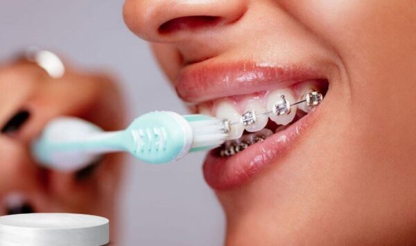 Người niềng răng nên sử dụng các loại kem đánh răng chuyên dụng. 
