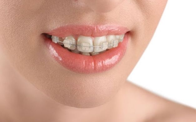Vì sao niềng răng xong vẫn xấu? Có nên niềng lại hay không?