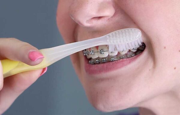 Chăm sóc răng miệng thật kỹ trong khi niềng răng 