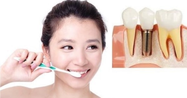 Chú ý các biểu hiện sau khi trồng răng implant để đảm bảo hồi phục 