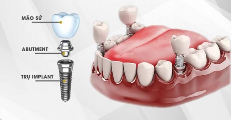 Cắm implant là phương pháp điều trị thẩm mỹ trong nha khoa.