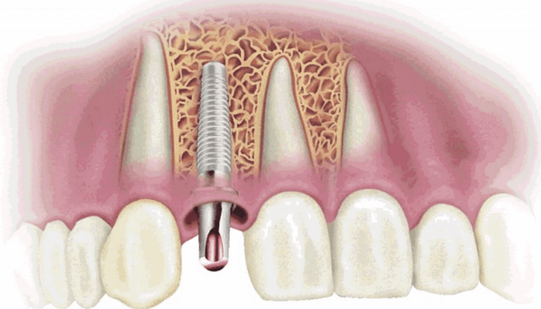 Điều trị răng khi có dấu hiệu viêm nhiễm