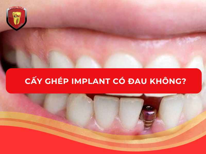 Cấy ghép Implant có đau không?