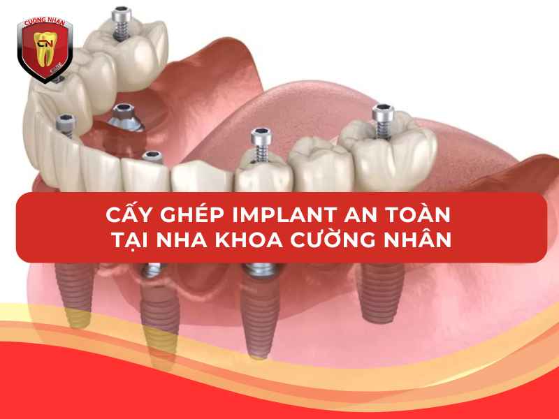 Cấy ghép Implant an toàn tại Nha Khoa Cường Nhân